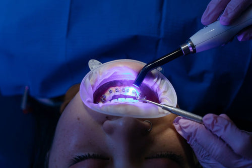 At-home LED kit or anti-stain toothpaste: which should you choose?